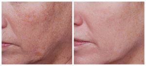 before after Nu Derm + Tretinoin