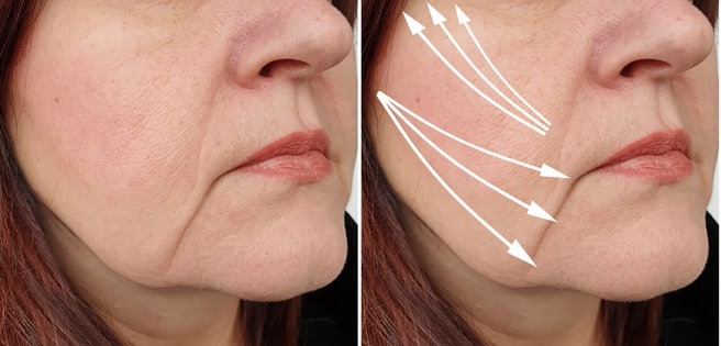woman face wrinkles after treatment