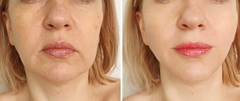 woman face lift after treatment